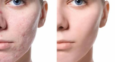 BHA Akne Ve Gözenek Temizleyici Nedir?