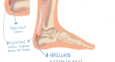 Haglund Deformitesi: Topukta Kemik Çıkıntısı Sandığınızdan Fazla Ciddiye Alınmalı mı?