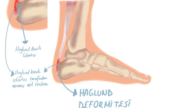 Haglund Deformitesi: Topukta Kemik Çıkıntısı Sandığınızdan Fazla Ciddiye Alınmalı mı?